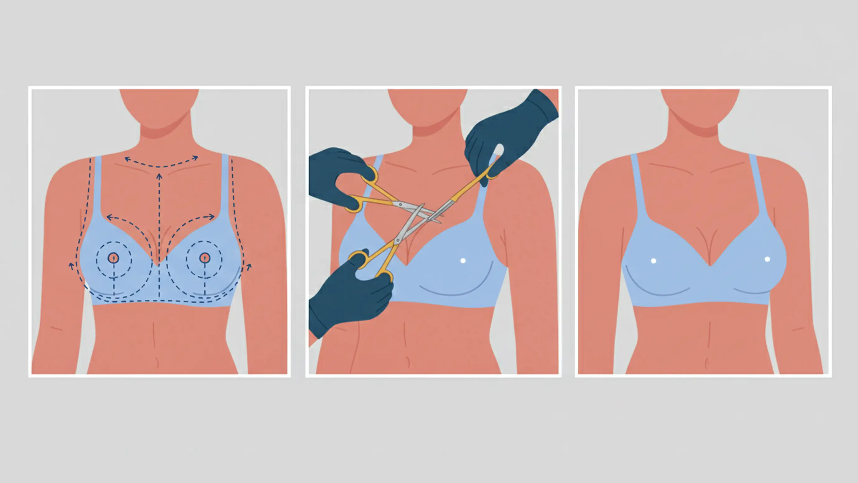 Anchor Breast Lift